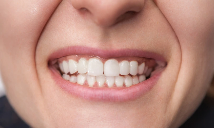 Smile Makeover - After