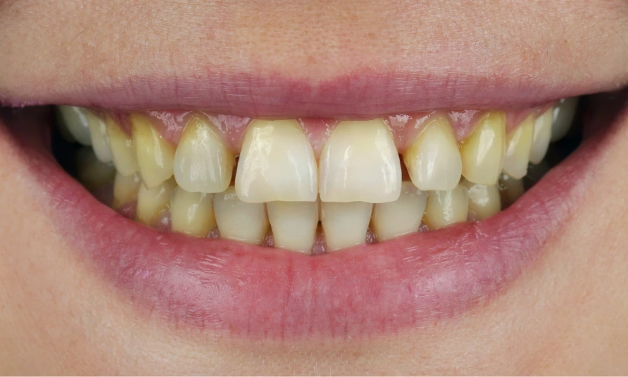 Teeth Whitening - Before