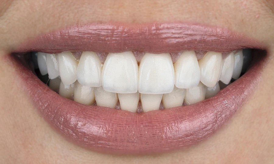 Teeth Whitening - After